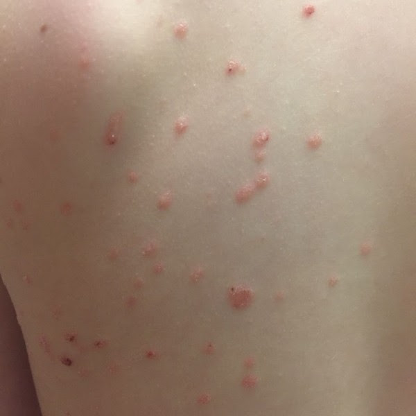 Epstein Barr Virus Rash-Epstein-Barr Virus-Symptoms-Diagnosis-Allopathic and Homeopathic Treatment | Homeopathic | Best Homeopathic Doctor in Pakistan | Dr Qaisar Ahmed MD, DHMS