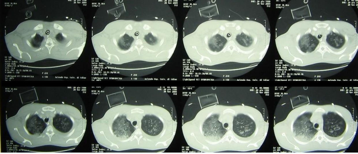 Chest CT during ICU stay.png