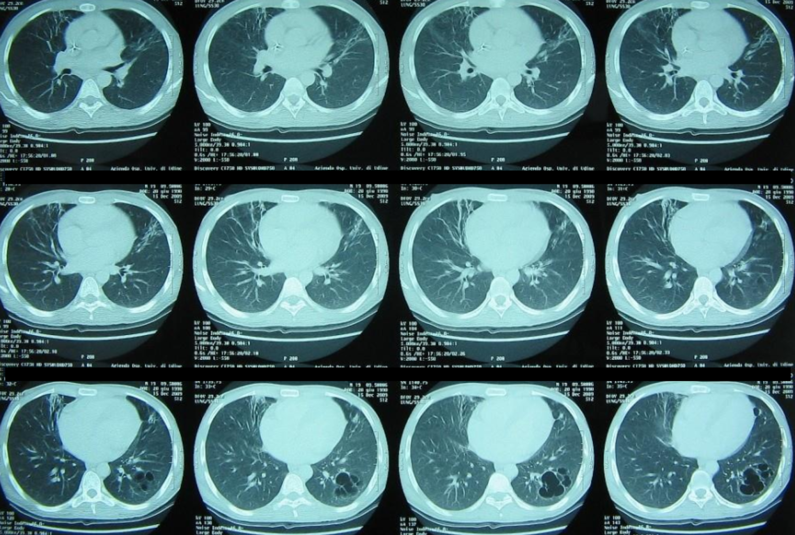 Follow-up chest CT.png